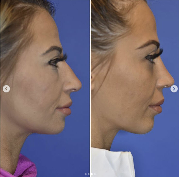 closed rhinoplasty bulbous tip